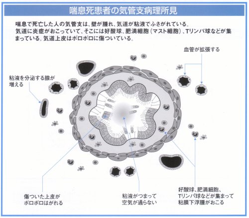 ぜんそく死患者の気管支病理所見