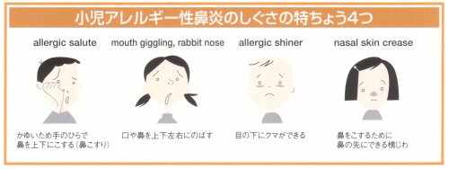 小児アレルギー性鼻炎のしぐさの特ちょう4つ